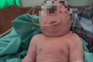 Geger! Bayi Bermata Satu dan Tanpa Hidung Lahir di Mandailing Natal